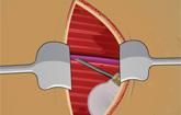 Pacemaker Surgery